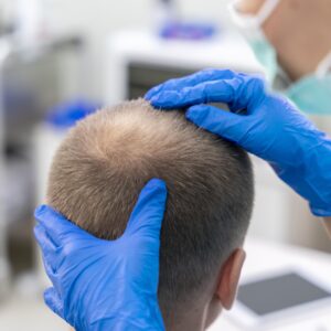 Hombre canoso con un patrón de caída del cabello